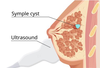 Göğüs vektörü illüstrasyonunun ultrasonu. Basit sonografi.