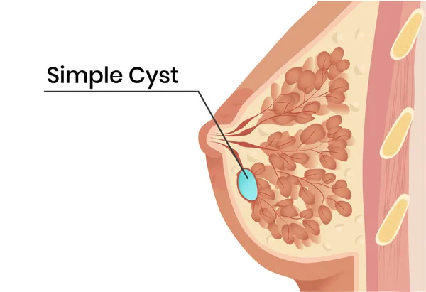 Eenvoudige Borst Cyste Anatomie Illustratie Vector Illustratie Van Cystische Laesie — Stockvector