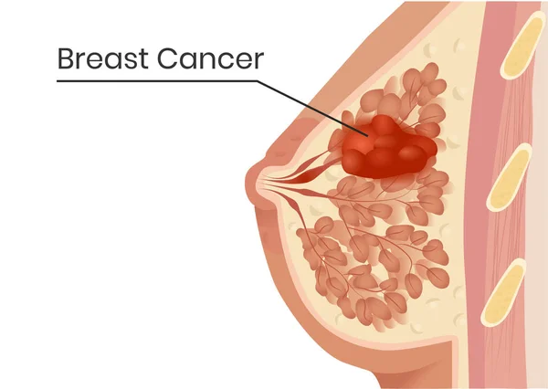 Estructura Del Cáncer Mama Ilustración Vectorial Del Carcinoma Lobular Con — Vector de stock