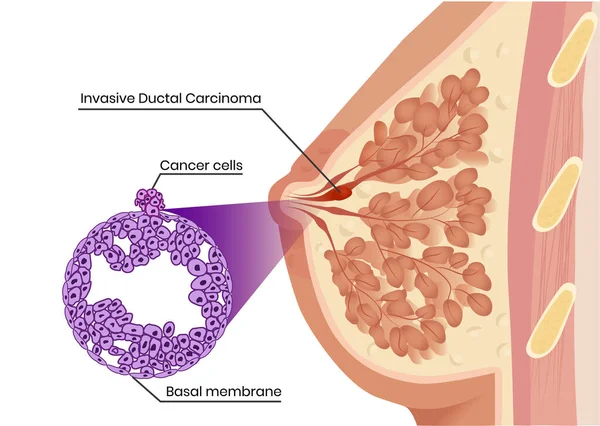 Invasiv Duktalcancer Sctructure Och Patologi Skildrar Cancerceller Piratkopiering Basala Membranet — Stock vektor