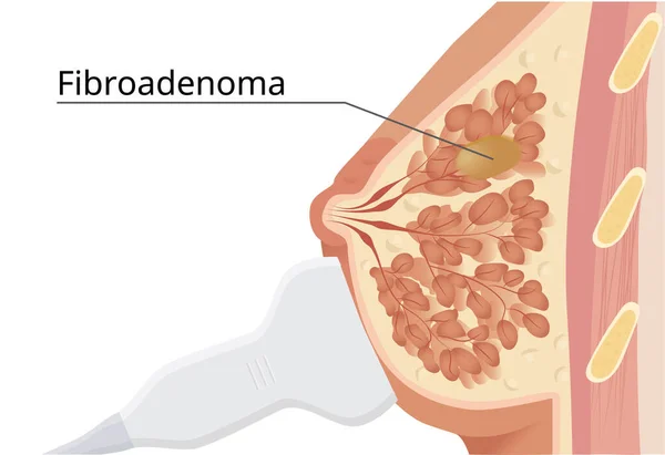 Ultrassom Mama Procedimento Ultrassonografia Com Fibroadenoma — Vetor de Stock