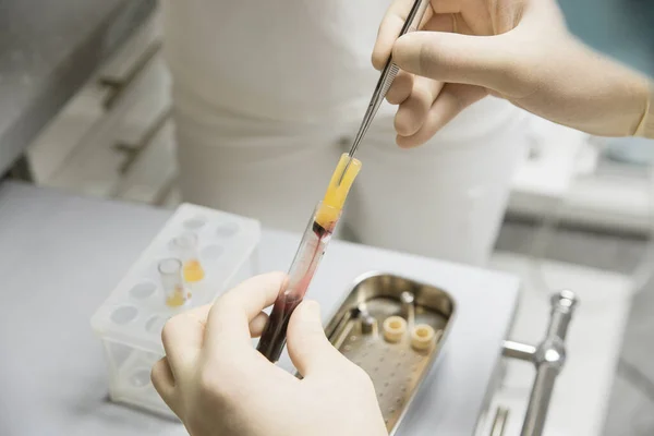 Kan plazması. Protezler için plazma. Diş Hekiminde Plasma