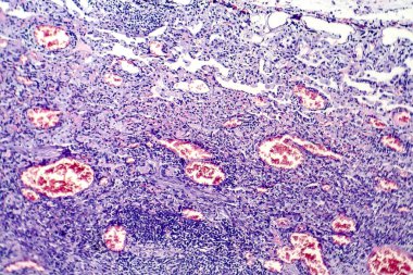 Tüberküloz lezyon histopatoloji