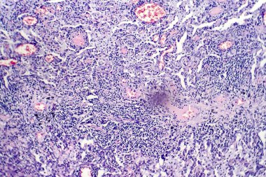 Tüberküloz lezyon histopatoloji