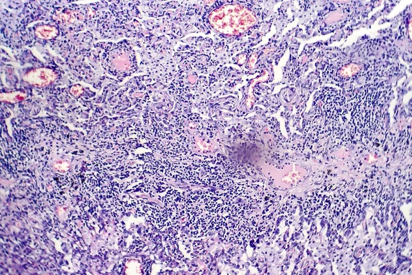 Tüberküloz lezyon histopatoloji