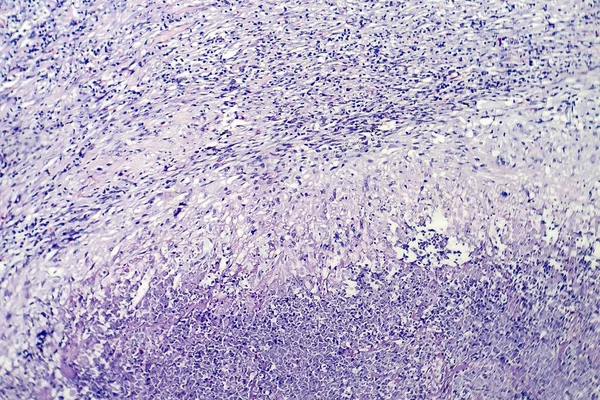 Histopathology of tuberculosis lesion