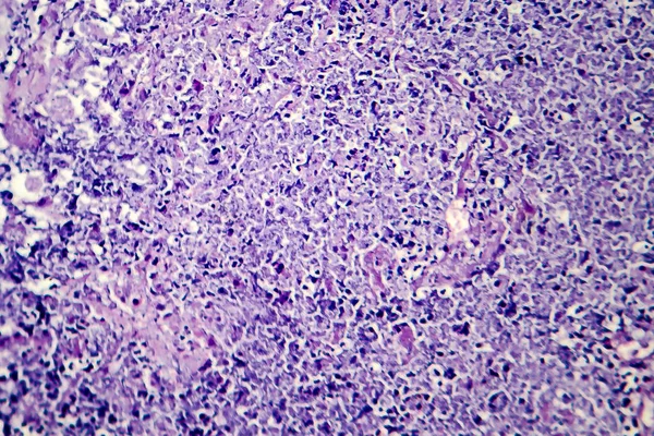 Histopathology 결핵 병 변의 — 스톡 사진