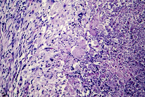 Histopathology 결핵 병 변의 — 스톡 사진