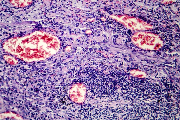 Histopatologi av tuberkulos lesion — Stockfoto