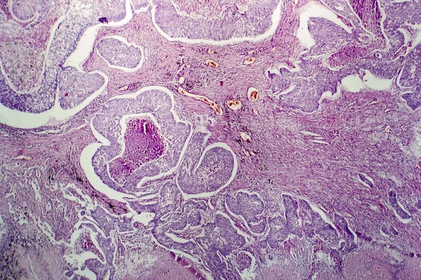 Adenocarcinoma do pulmão, micrografia de luz — Fotografia de Stock