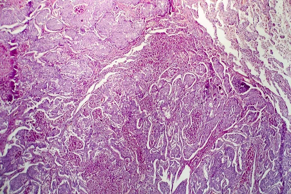 Adenocarcinoma de pulmón, micrografía ligera — Foto de Stock