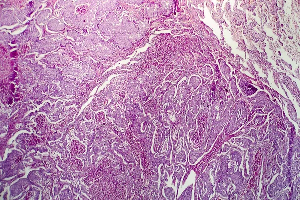 Adenocarcinoma do pulmão, micrografia de luz — Fotografia de Stock