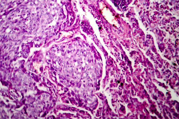 Lung adenocarcinoma, light micrograph