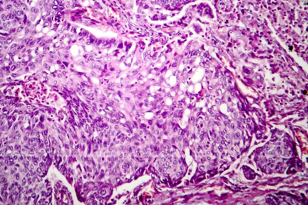 Adenocarcinoma do pulmão, micrografia de luz — Fotografia de Stock