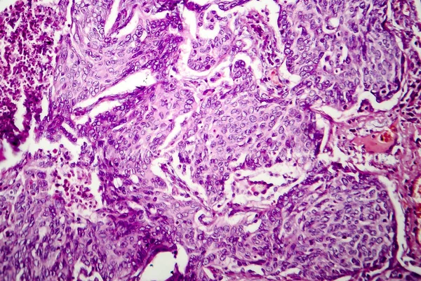 Adenocarcinoma do pulmão, micrografia de luz — Fotografia de Stock