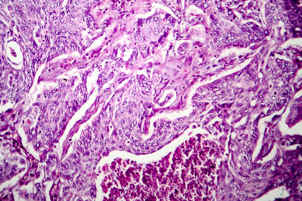 Lung adenocarcinoma, light micrograph