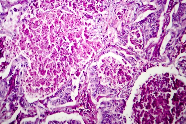 Lung adenocarcinoma, mikrograf cahaya — Stok Foto