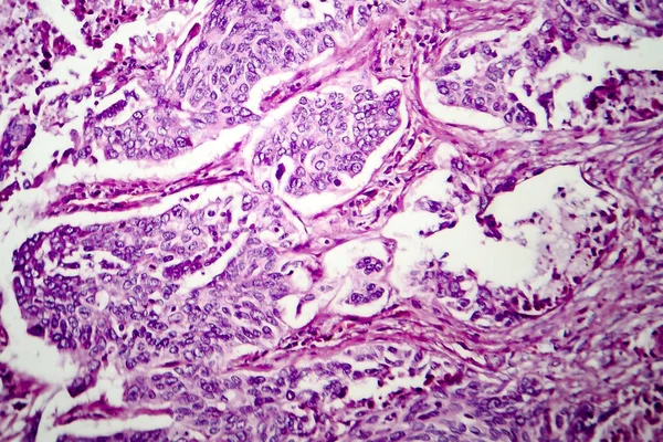 Adenocarcinoma do pulmão, micrografia de luz — Fotografia de Stock