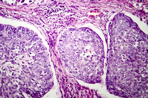 Adenokarcinom plic, lehké mikrofotografie — Stock fotografie