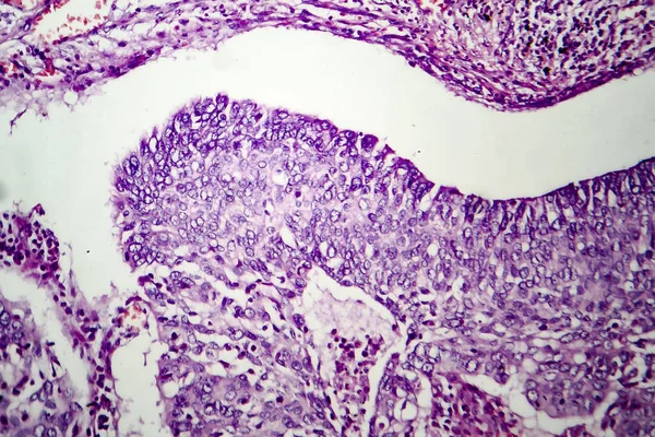 Adenocarcinoma de pulmón, micrografía ligera —  Fotos de Stock