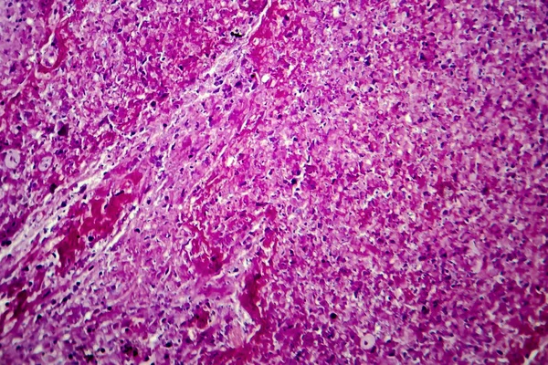 人間の結核の肉芽腫、光学顕微鏡像の乾酪 — ストック写真