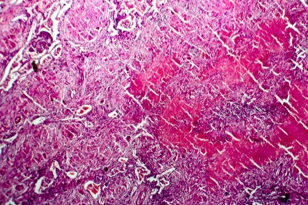 Miliaria tüberkülozu, ışık test — Stok fotoğraf