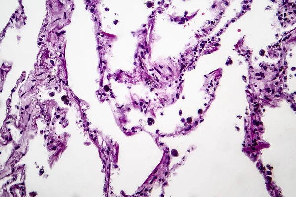 Lungenemphysem, leichte Mikrographie — Stockfoto