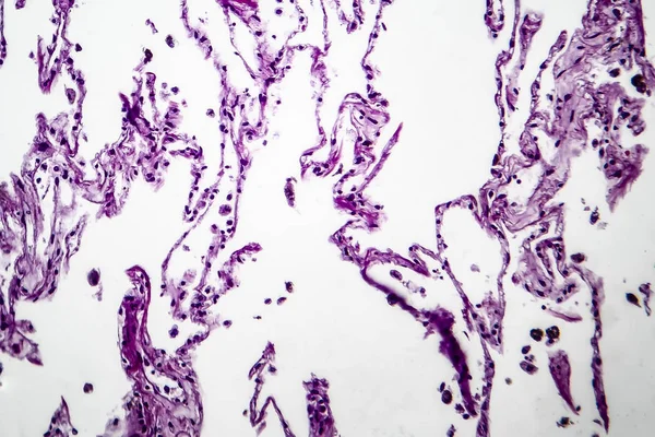 Enfisema pulmonar, micrografía ligera — Foto de Stock