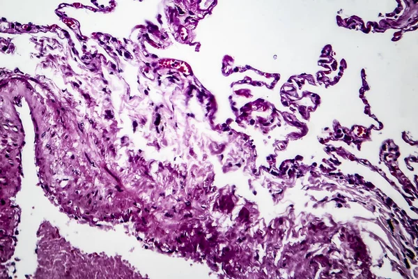 Enfisema pulmonar, micrografia de luz — Fotografia de Stock