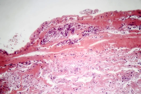 Pleurisy tuberkulosis, mikrograf cahaya — Stok Foto