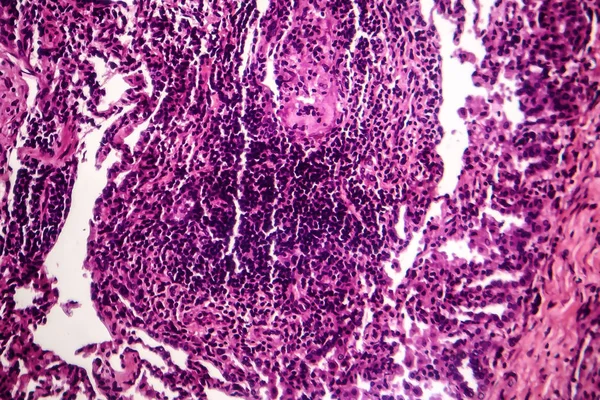 Pneumonia caseosa, micrografia de luz — Fotografia de Stock