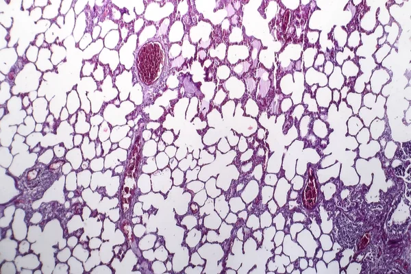 Pneumonia, micrografia de luz — Fotografia de Stock