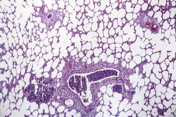 Pneumonie, lehké mikrofotografie — Stock fotografie