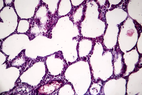 Neumonía, micrografía ligera — Foto de Stock