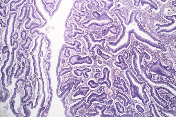 Adenomas intestinais, micrografia de luz — Fotografia de Stock