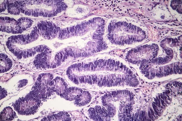 Adenomas intestinais, micrografia de luz — Fotografia de Stock