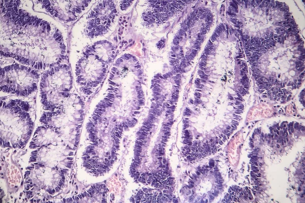 Adenoma usus, mikrograf cahaya — Stok Foto