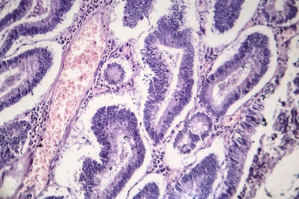腸腺腫、光学顕微鏡像 — ストック写真
