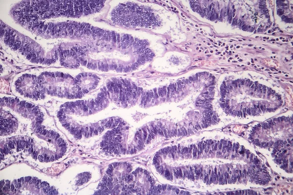 Adenomi intestinali, micrografo leggero — Foto Stock
