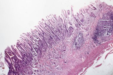 Kronik atrofik gastrit, ışık test