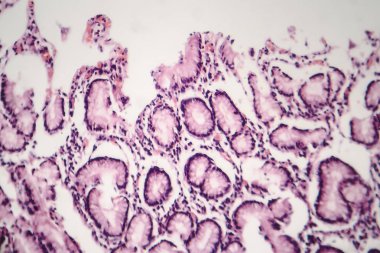 Kronik atrofik gastrit, ışık test