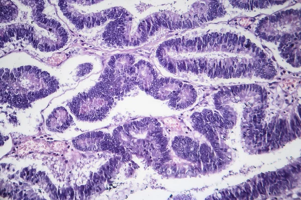 Adenomas intestinais, micrografia de luz — Fotografia de Stock