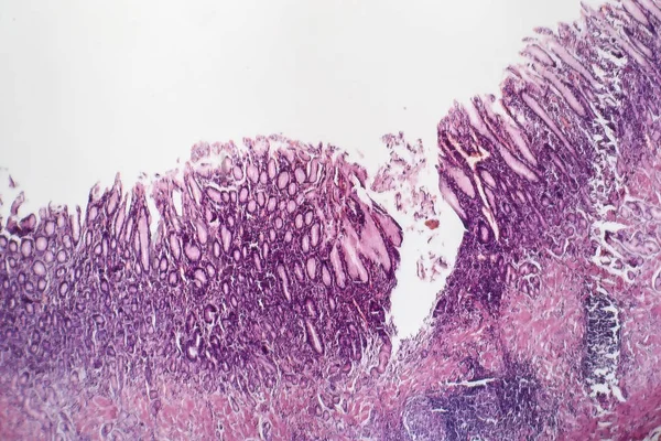 Gastritis atrófica crónica, micrografía ligera —  Fotos de Stock