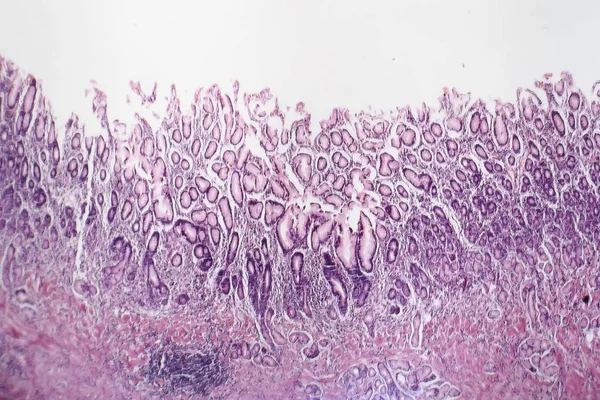 Kronik atrofik gastrit, ışık test — Stok fotoğraf