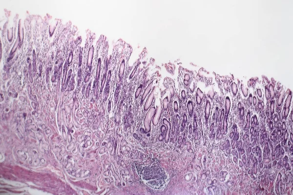 Krónikus atrophiás gastritis, könnyű elektronmikroszkópos — Stock Fotó