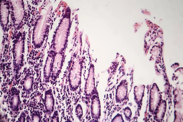 Chronic atrophic gastritis, light micrograph — Stock Photo, Image
