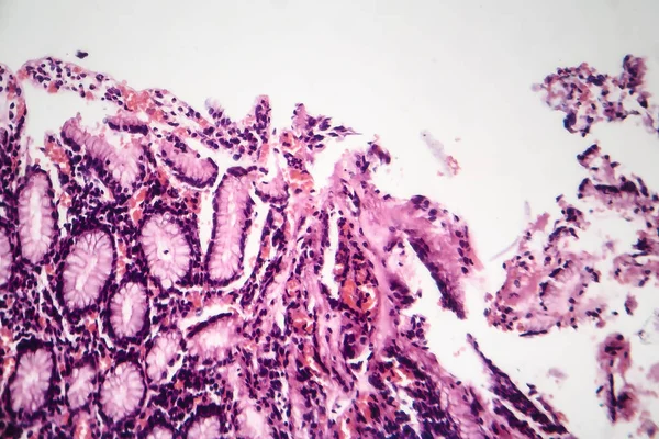 Kronik atrofik gastrit, ışık test — Stok fotoğraf