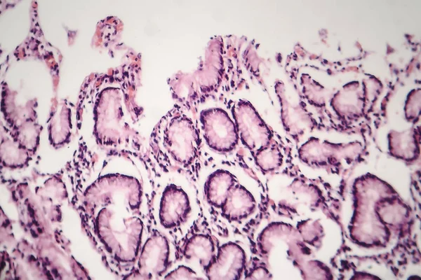 慢性萎縮性胃炎、光学顕微鏡像 — ストック写真