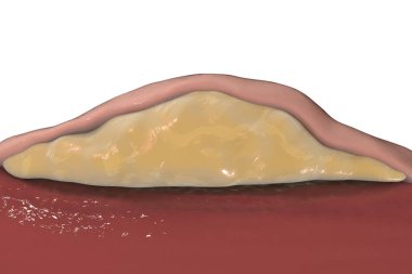 Lipoma, cross-section view clipart