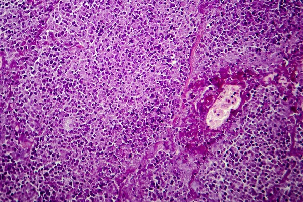 Penyebab dari tuberkulosis granuloma manusia, mikrograf cahaya — Stok Foto